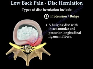 low back pain   disc herniation ,sciatica   everything you need to know   dr. (900 720)